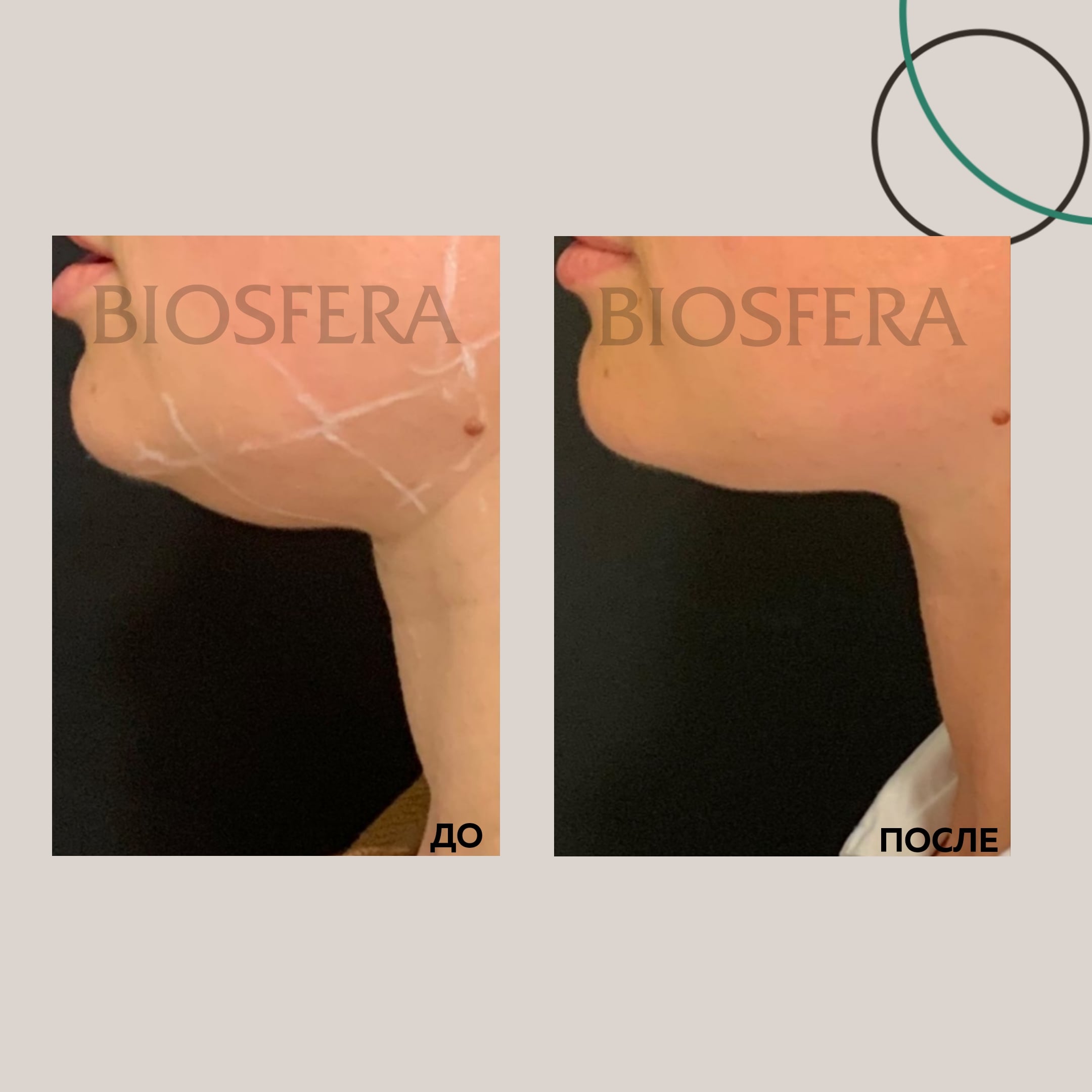 3D-лифтинг INFINI 3D-лифтинг INFINI