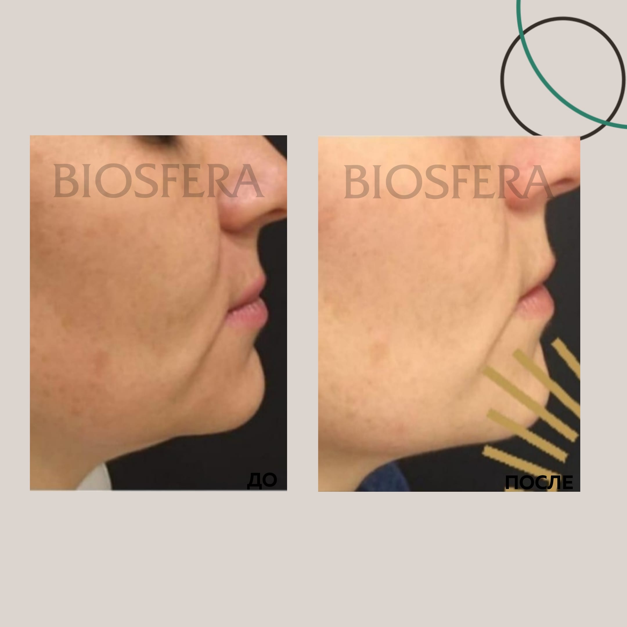 3D-лифтинг INFINI (фото до\после) 3D-лифтинг INFINI(фото до\после)