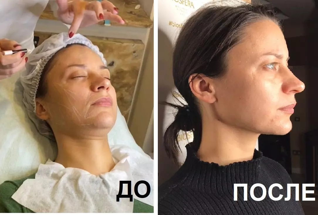 Плазмотерапия Плазмотерапия