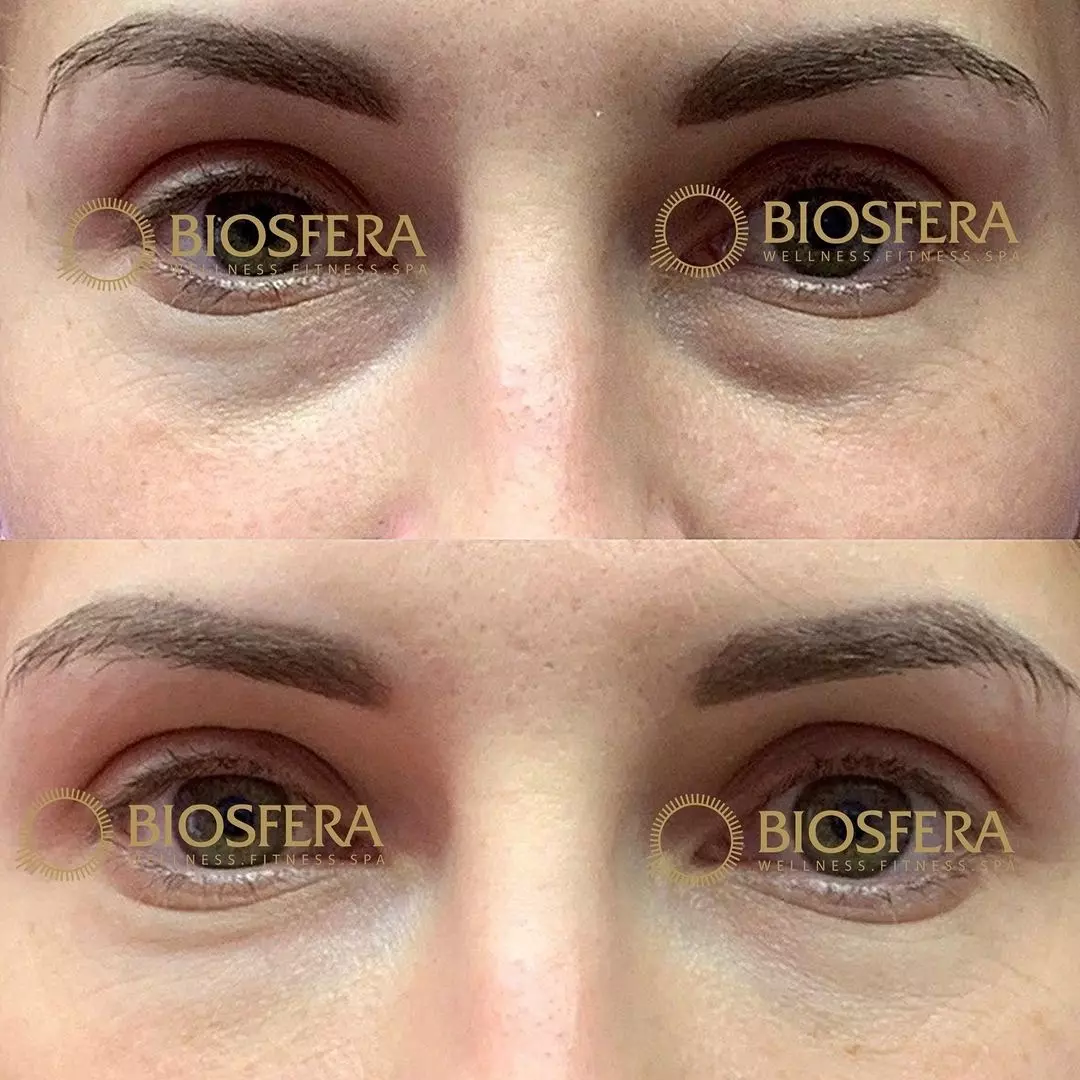 Как убрать тёмные круги под глазами от MediSPA центр BIOSFERA Как убрать тёмные круги под глазами